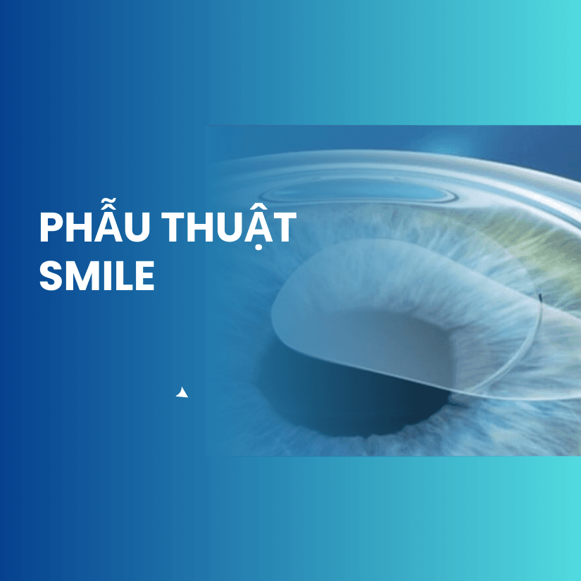 Phẫu thuật SMILE (ReLEx SMILE)